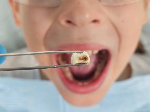 Best Emergency Dental Care for Broken or Chipped Teeth in Bloomfield, MO