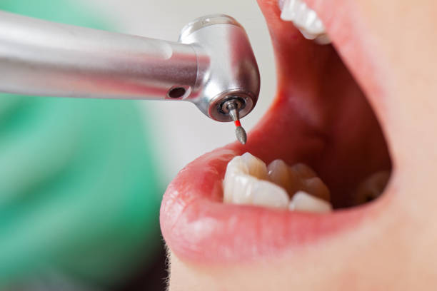 Best Emergency Gum Treatment in Bloomfield, MO